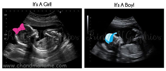 عکس سونوگرافی جنین دختر